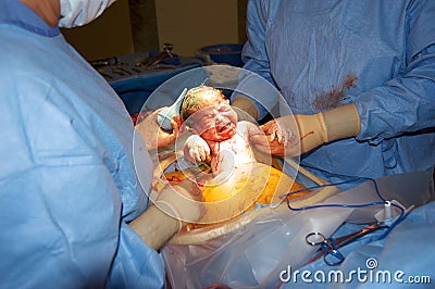 Newborn during caesarean section