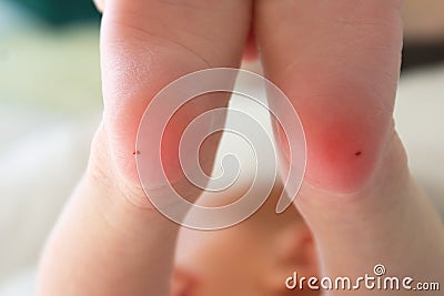 Newborn heel prick test and lood puncture. Stock Photo