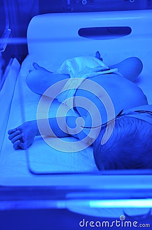 Newborn jaundice Stock Photo