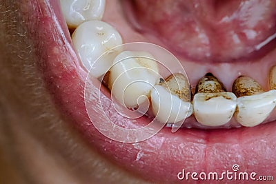 Nicotine and caffeine stains on bottom teeth Stock Photo