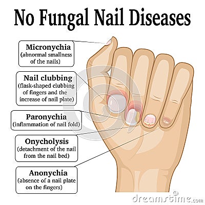 No Fungal Nail Disease Vector Illustration