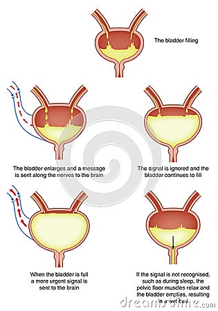 Nocturnal enuresis (bed-wetting) Vector Illustration