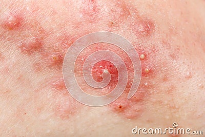 Nodular cystic acne skin Stock Photo