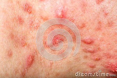 Nodular cystic acne skin Stock Photo