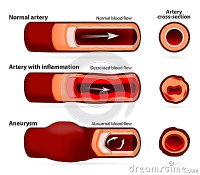 Normal artery, inflamed or narrowed artery and artery with an an Vector Illustration