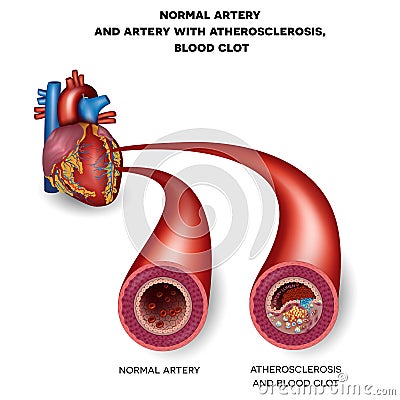 Normal artery and unhealthy artery Vector Illustration