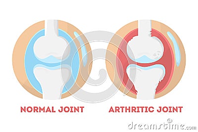 Normal and arthritic human joint anatomical infographic Vector Illustration