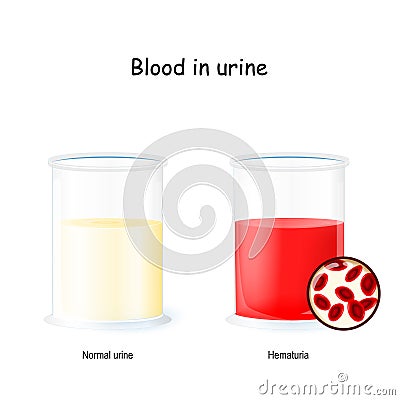 Normal and bloody urine. two beaker with urine. Hematuria is the presence of red blood cells in the urine Vector Illustration