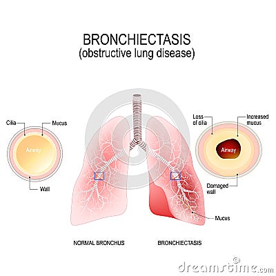 Normal bronchus and bronchiectasis. obstructive lung disease Vector Illustration