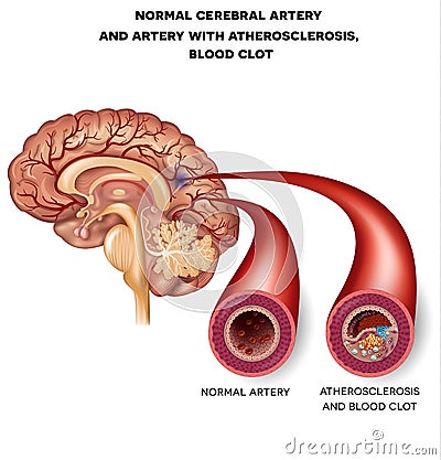 Normal cerebral artery and artery with blood clot Vector Illustration