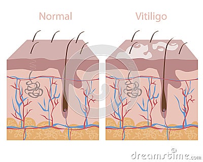 Depigmented skin with vitiligo and healthy skin isolated on a white background, flat stock vector illustration anatomical with Vector Illustration