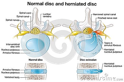 Normal disc and herniated disc, slipped disc, labelde illustration Cartoon Illustration