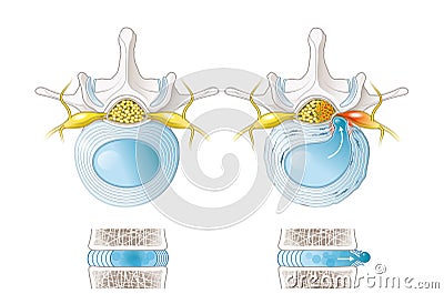 Normal disc and herniated disc, slipped disc, labelde illustration Cartoon Illustration