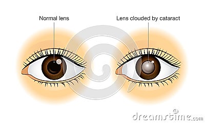Normal eye and lens clouded by cataract. Vector Illustration