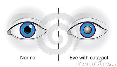 Normal eye and lens clouded by cataract. Vector Illustration