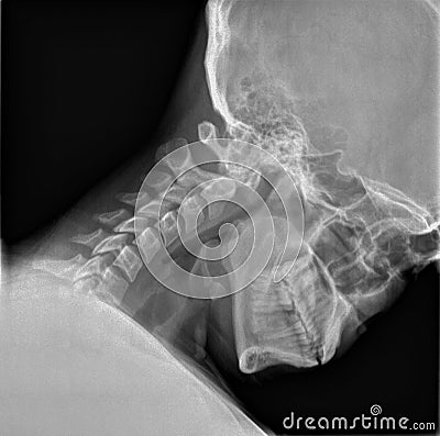 Normal film xray or radiograph of a cervical neck. Lateral flexion view which is the best way to see Spondylolisthesis and to Stock Photo