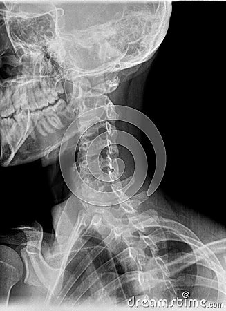 Normal film xray or radiograph of a cervical neck. Lateral slightly oblique view to see if any fracture of the pars inarticularis Stock Photo