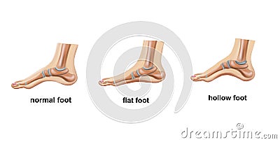 Normal foot, flat foot and hollow foot Stock Photo