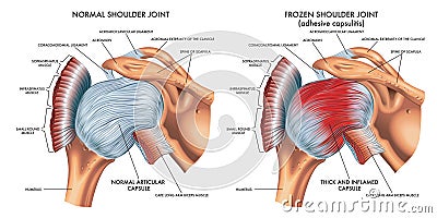 Normal and frozen shoulder joints Vector Illustration
