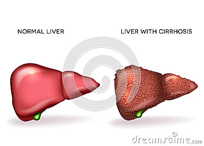 Normal healthy liver and Liver with Cirrhosis Vector Illustration