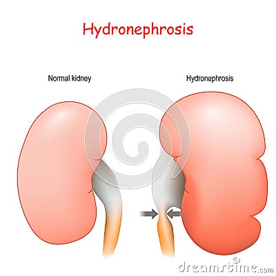 Normal human`s kidney and kidney affected by Hydronephrosis Vector Illustration