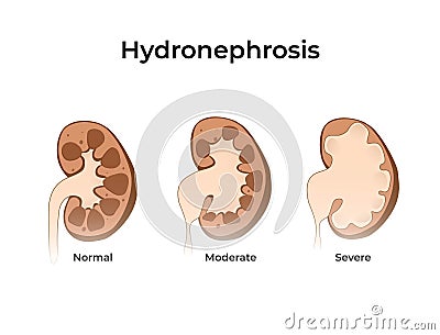 Normal kidney with hydronephrosis. Vector illustration of the of the kidney anatomy with dilated kidneys Vector Illustration