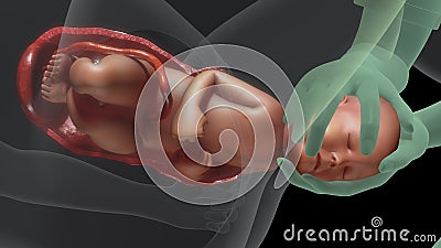 Normal labor and vaginal birth Stock Photo