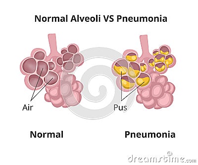 Normal lung alveoli versus pneumonia Vector Illustration