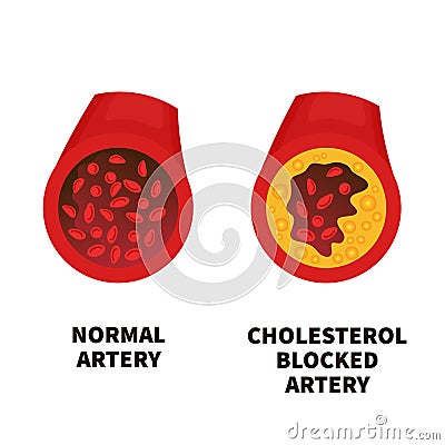 Normal and narrowed artery cross section illustration Cartoon Illustration