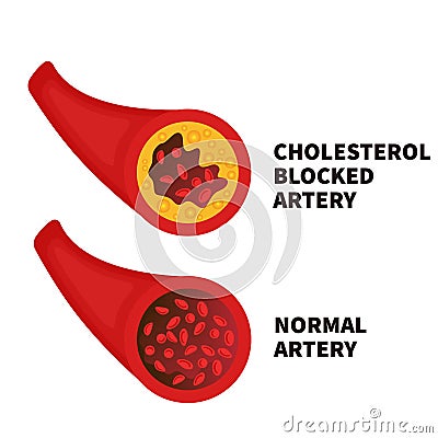 Normal and narrowed artery cross section illustration Vector Illustration