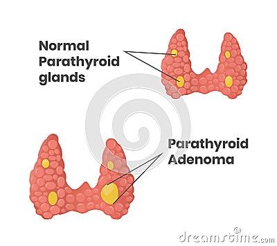 Normal parathyroid glands with parathyroid adenoma Vector Illustration