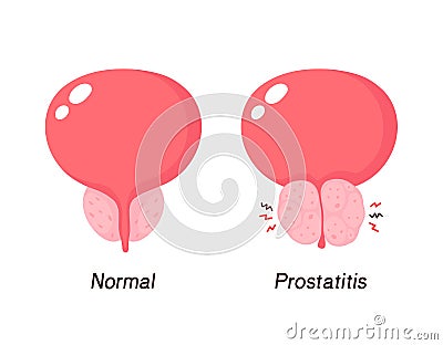 Normal prostate and benign prostatic hyperplasia Vector Illustration