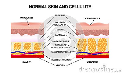 Normal skin and cellulite. illustration with symbols Vector Illustration