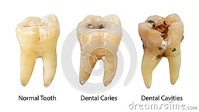 Normal tooth , Dental caries and Dental cavity with calculus . Comparison between difference of teeth decay stages . White Stock Photo