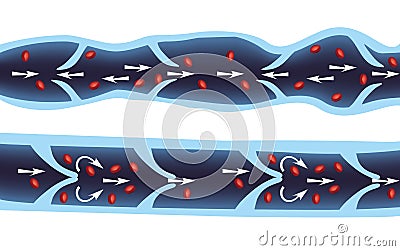 Normal Vein and varicose vein Vector Illustration