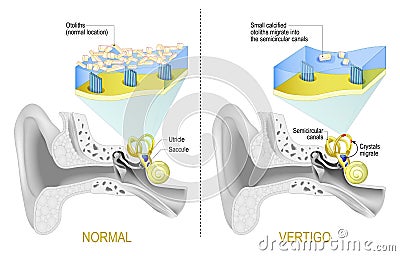 Normal vestibular system and Vertigo when Small calcified otoliths migrate from Saccule and Utricle into the semicircular canals Vector Illustration