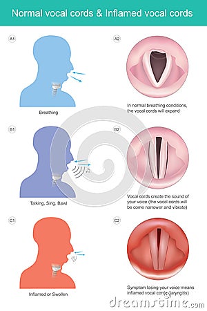 Normal vocal cords & Inflamed vocal cords. Stock Photo