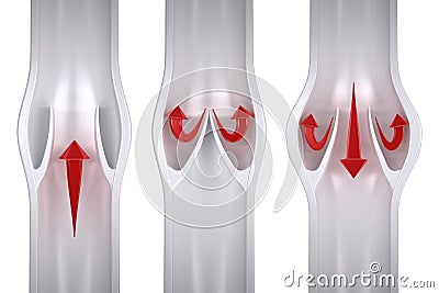 Normal vs Varicose - Vein Anatomy Stock Photo