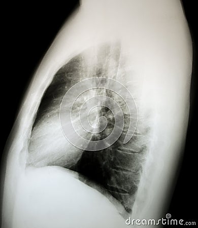 Normal x-ray of the chest, lateral Stock Photo