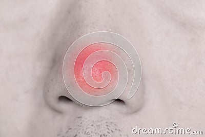 Nose Acne tip in male Stock Photo