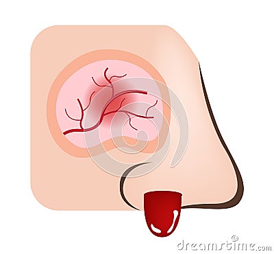 Nose bleeding / inflamed nasal and sinus Vector Illustration