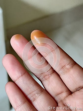 Not wearing gloves might lead to acid burning on fingers during laboratory work Stock Photo
