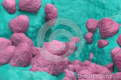 Non Small Cell Lung Cancer NSCLC in the lung tissue â€“ closeup view 3d illustration Stock Photo