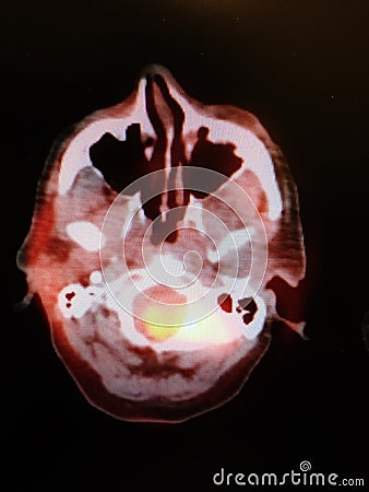 Nuclear medicine pet ct head neck oncology diagnostic Stock Photo