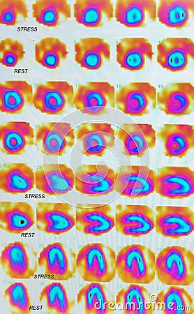 Nuclear myocardial perfusion stress test Stock Photo