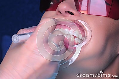 Nurse applying gel for LED whitening woman patient teeth in dentistry, closeup. Stock Photo