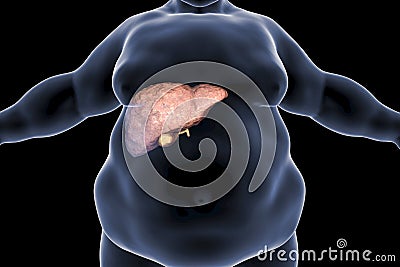Obese man with fatty liver Cartoon Illustration