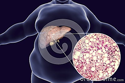 Obese man with fatty liver Cartoon Illustration