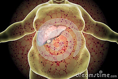 Obese man with fatty liver Cartoon Illustration