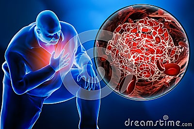 Obese or overweight man suffering a heart attack or a pulmonary embolism with a close-up image of a blood clot 3D rendering Cartoon Illustration